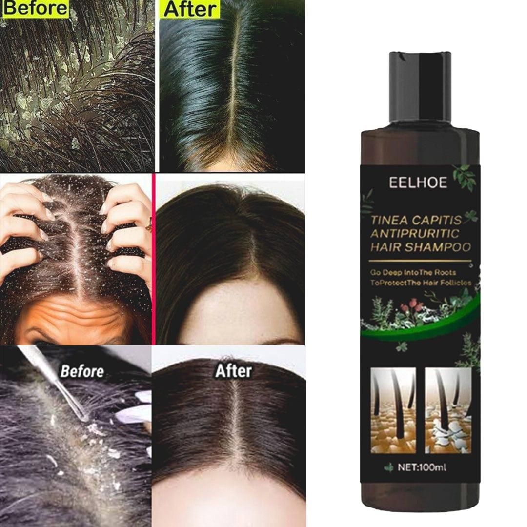 Tinea Capitis Antipruritic Hair Shampoo 100ml Each (Pack of 2)